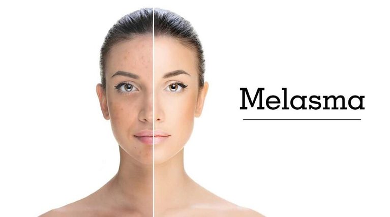 Melasma en la cara - Marketeando.ec